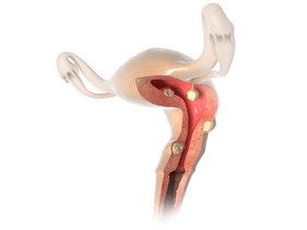 uterus-befund-myom-polyp-160916_LQ