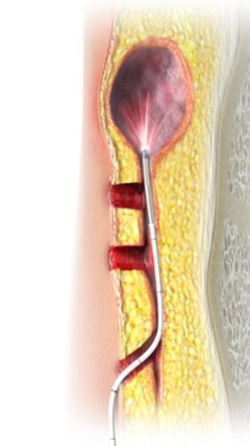 Steissbeinfistelbehandlung_mit_der_SiLaC_R_-Methode_der_biolitec_R__hoch